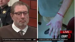 Paul Caneiro's Injured Hands Shown To Jury