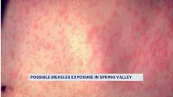 Rockland health officials warns of possible measles exposure in Spring Valley