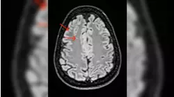 What to know about whole-body MRI scans