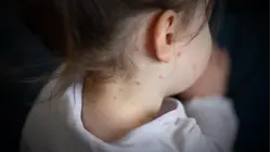 Measles cases reach highest level since 1991