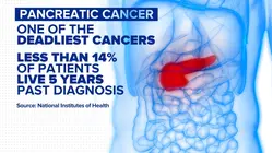 New blood test could detect pancreatic cancer