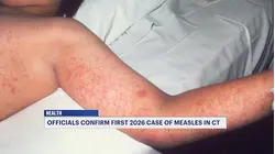 Children are the most at risk for being diagnosed with measles, DPH Commissioner says