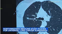 Study recommends expanding lung cancer screening ages