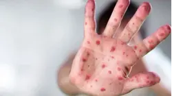 Measles Outbreak in South Carolina Doubles in a Week