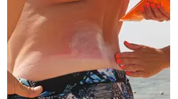 Doctor shares ways to prevent sunburn and protect skin during summer