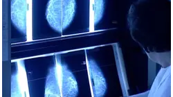 Young women can get breast cancer too, making early awareness critical