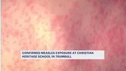 Connecticut reports 1st measles case since 2021
