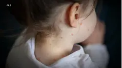 Measles outbreak in South Carolina is over, health officials say