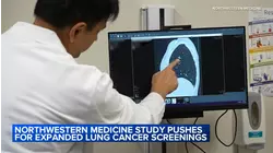 Chicago study pushes for expanded lung cancer screenings