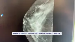 Breast cancer myths debunked: Doctor explains facts about mammograms, deodorant and breast injuries