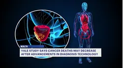 Advances in prostate cancer detection may lower deaths, according to Yale study