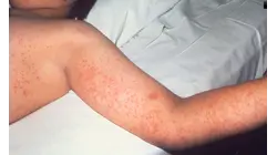 Connecticut becomes one of first states to join new U.S. disease tracking system