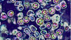 Health Officials Report 2 Measles-Related Deaths in Pennsylvania