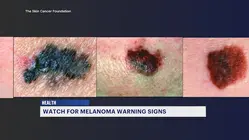 Melanoma is the most serious type of skin cancer. Here's what you need to know.