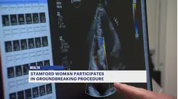 Stamford woman participates in groundbreaking procedure to repair leaky heart valve