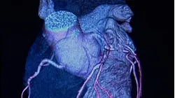 Study names financial stress a risk factor for cardiovascular disease