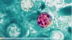 Cyclosporiasis Outbreaks Hits More Than Half of the US
