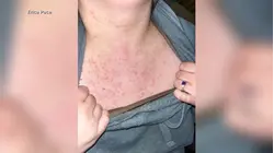 Measles outbreak in South Carolina grows larger