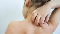 Measles Outbreak Spreads in South Carolina With 400+ Cases