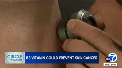 More sun-smart than sunscreen? How a simple supplement may shield your skin