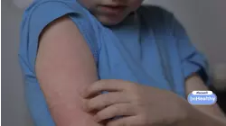 Tips to help children impacted by eczema