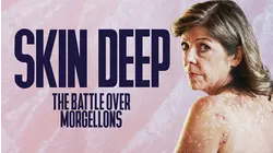 Skin Deep: The Battle Over Morgellons