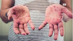 Measles Outbreak in South Carolina Becomes Largest in the US