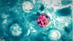 Cyclosporiasis cases surge after RFK Jr. said  outbreak was contained
