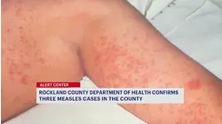 3 new measles cases confirmed in Rockland County