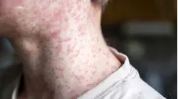 New York declares state of emergency over measles outbreak 