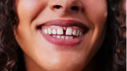 ¿Qué es un diastema dental y cómo se produce? Un dentista responde
