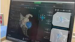 New medical tech at St. Agnes helps ease severe shoulder pain