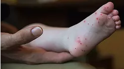 Hand, foot and mouth disease on rise in certain areas