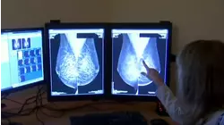 Los nuevos tratamientos alargan la esperanza de vida de los pacientes con cáncer