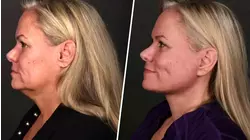 Demand for Cosmetic Surgery Spikes Among Younger Patients