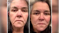 Rosie O'Donnell opens up about facelift