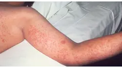 Ebola and measles warnings as large crowds expected for World Cup