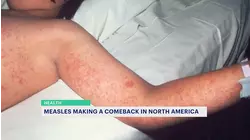 Health experts warn travelers about rise in measles cases