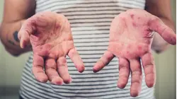 South Carolina Measles Cases Double in Just 1 Week