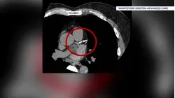 Why doctors say tracking triglycerides is key to protecting your heart health