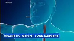 Magnetic technique offers alternative to bypass weight loss surgery