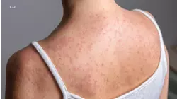 Hundreds of South Carolina students quarantined over measles exposure