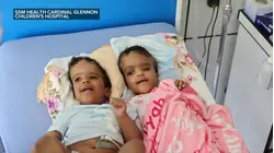 Conjoined twins begin new chapter after successful separation