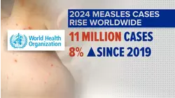 Measles surge sparks global concern