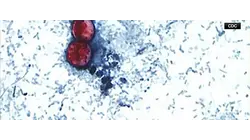 Up to 200 cyclosporiasis cases reported in New Jersey