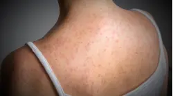 Measles cases top 900