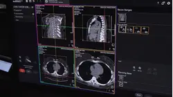 How AI and new tech are fighting the tri-state's deadliest cancer