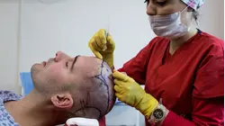 Inside Turkey's $2B Hair Transplant Tourism Boom