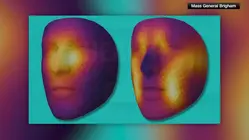 New AI model estimates cancer survival rate based on face photos