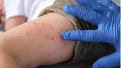 Growing Pennsylvania measles outbreak